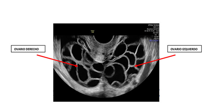Ilustración 4. Imagen de ambos ovarios en un Síndrome de Hiperestimulación Ovárica. Se identifican ambos ovarios con múltiples folículos desarrollados que aumentan el tamaño de los ovarios hasta que, en la imagen, llegan a contactar ambos