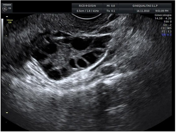 Ilustración 2.  Imagen de Ovario Poliquístico con típica disposición de múltiples folículos en la periferia del ovario en "rosario de perlas"