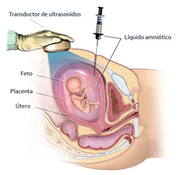 amniocentesis Ginequalitas reproducción