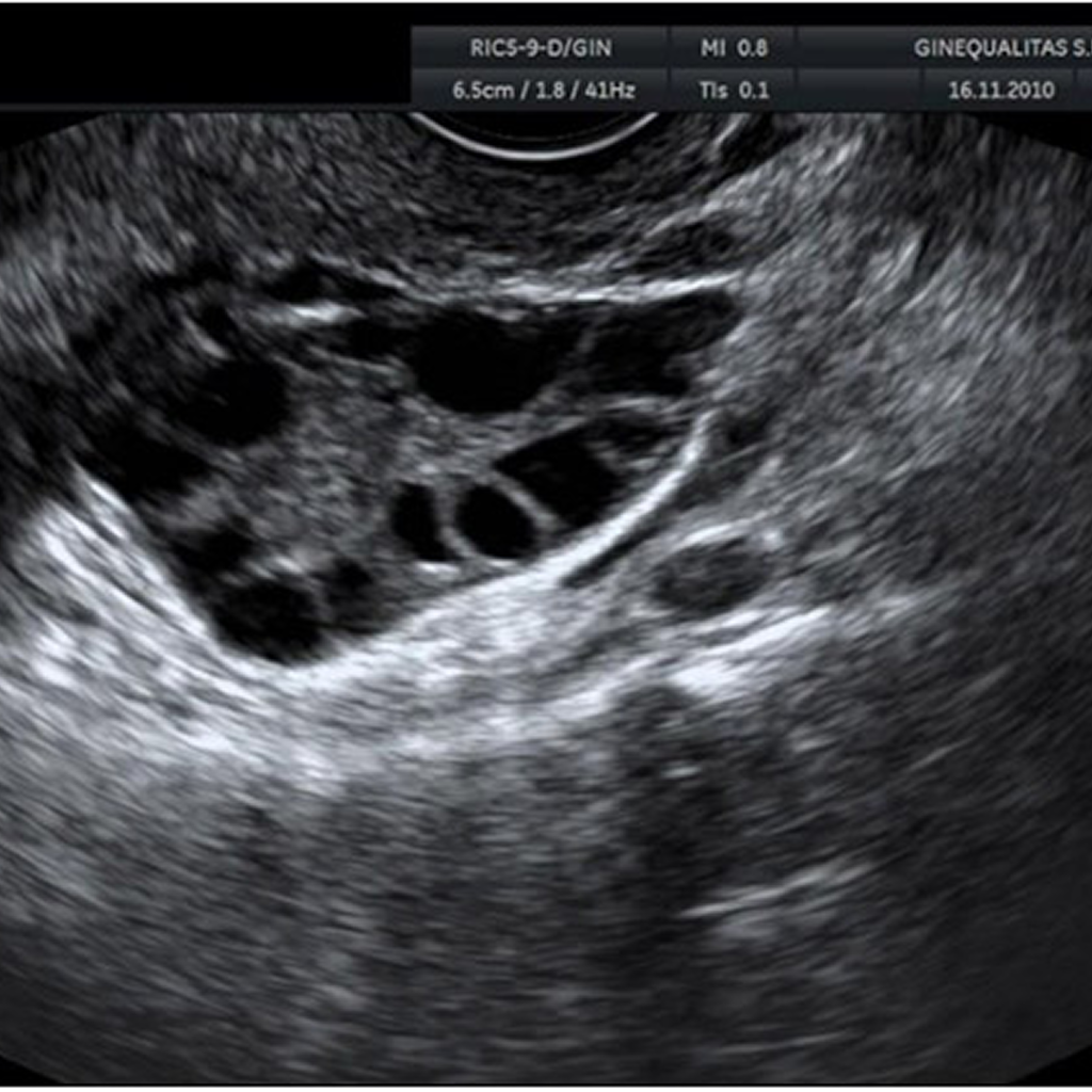Ecografías en el embarazo