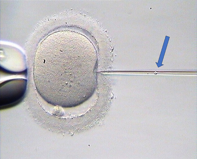 Ilustración 2  En el procedimiento de inyección intracitoplasmática (ICSI) se introduce un espermatozoide (flecha azul) en el interior del ovocito para facilitar la fecundación.