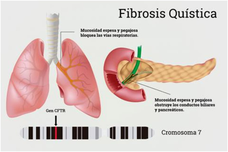 Ilustración 2.    Esquema de los órganos afectos en la Fibrosis Quística y dónde se ubica la mutación que produce la enfermedad.
