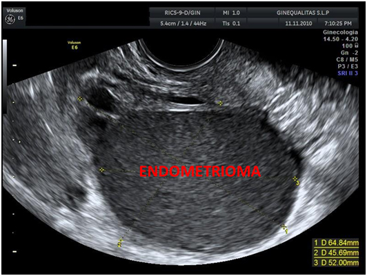 Endometriosis Ginequalitas