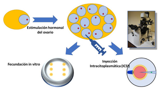 Ilustración 1. La estimulación hormonal del ovario para conseguir muchos óvulos susceptibles de ser recuperados en la punción folicular está en el origen del SHO. Éste es un esquema de la Fecundación In Vitrro /ICSI.