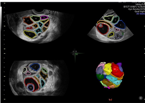 Ilustración 5. En esta imagen de un ovario durante un SHO  en 3 dimensiones se identifican múltiples folículos a los que se les ha asignado diferentes colores para identificarlos y medirlos