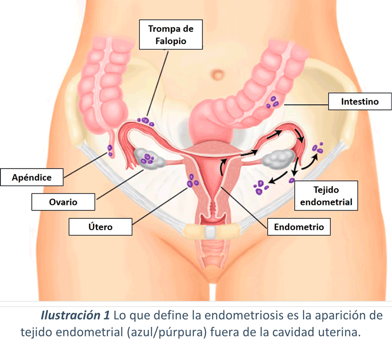 endometriosis1